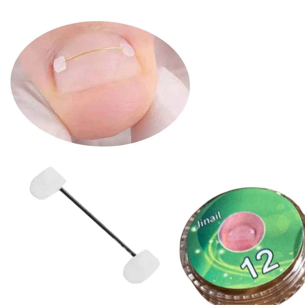 Kit Ajustable de Corrector de Uñas Encarnadas de Grado Médico, Herramienta de Cuidado para el Hogar de Acero Inoxidable